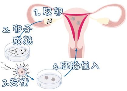 着床前診断 PGT